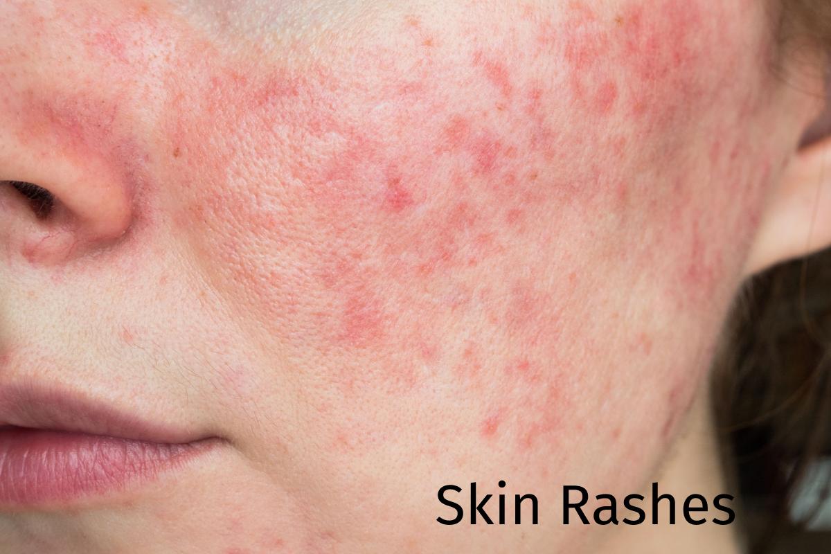 Skin s Rashes Stress And Other Different Reasons In Allure